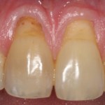 Gum Grafting