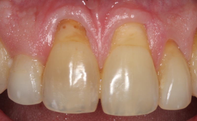Gum Grafting