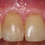 Gum Grafting