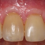 Gum Grafting