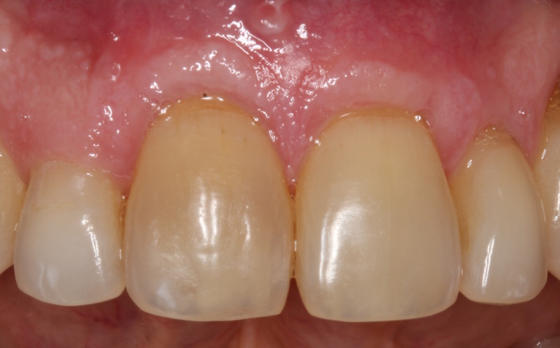 Gum Grafting