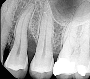 Guided Bone & Tissue Regeneration