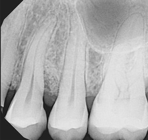 denatl Implants