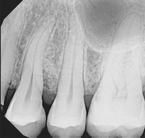 denatl Implants