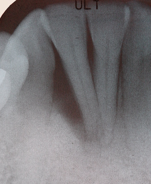 Cosmetic Periodontal Surgery