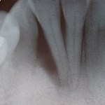 Cosmetic Periodontal Surgery