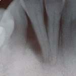 Cosmetic Periodontal Surgery