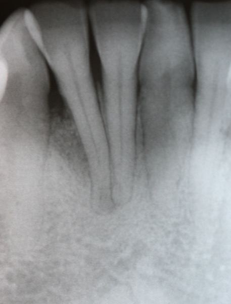 Cosmetic Periodontal Surgery
