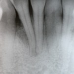 Cosmetic Periodontal Surgery