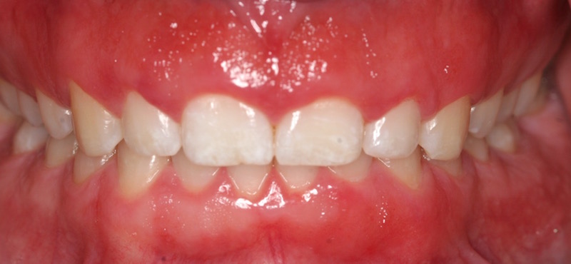 Cosmetic Periodontal Surgery