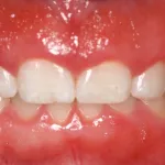 Cosmetic Periodontal Surgery
