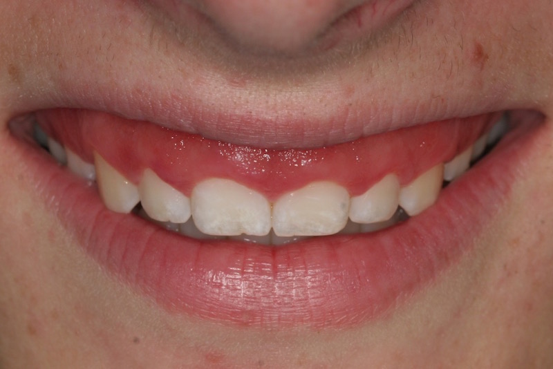 Cosmetic Periodontal Surgery