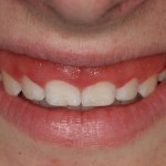 Cosmetic Periodontal Surgery