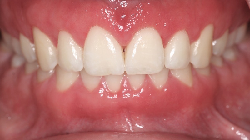 Cosmetic Periodontal Surgery