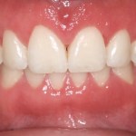 Cosmetic Periodontal Surgery