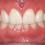 Cosmetic Periodontal Surgery