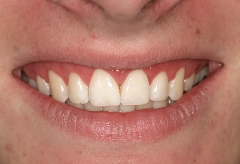 Cosmetic Periodontal Surgery