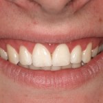 Cosmetic Periodontal Surgery