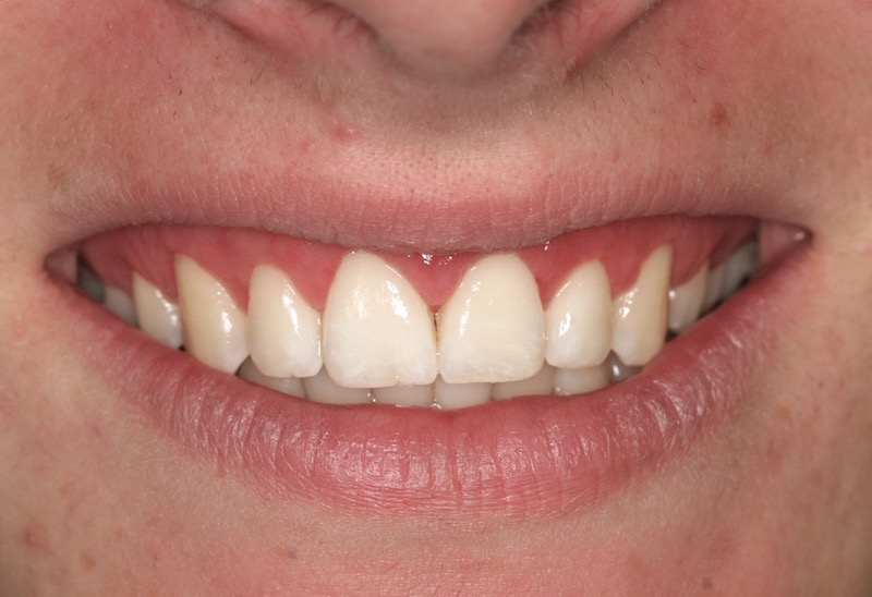 Cosmetic Periodontal Surgery
