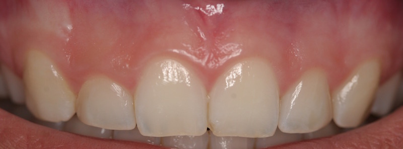 Cosmetic Periodontal Treatment Before and After Photos