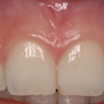 Cosmetic Periodontal Treatment Before and After Photos