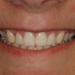 Before and After cosmetic periodontal treatment photos