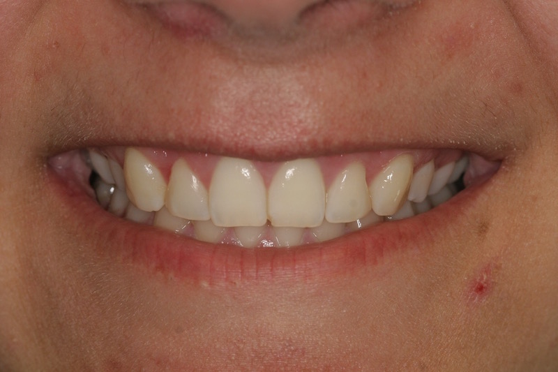 Before and After cosmetic periodontal treatment photos