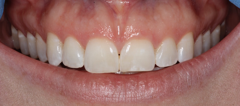Smile Gallery