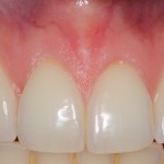 Image of smile after treatment