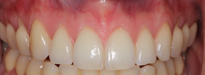 Image of smile after treatment