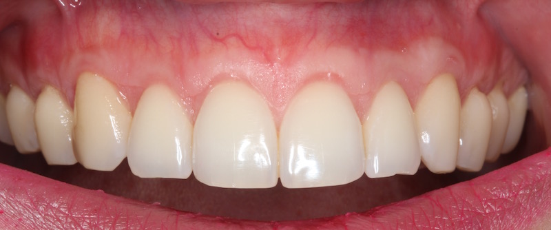 Image of smile after cosmetic periodontal treatments