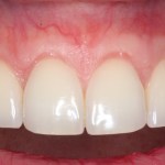 Image of smile after cosmetic periodontal treatments