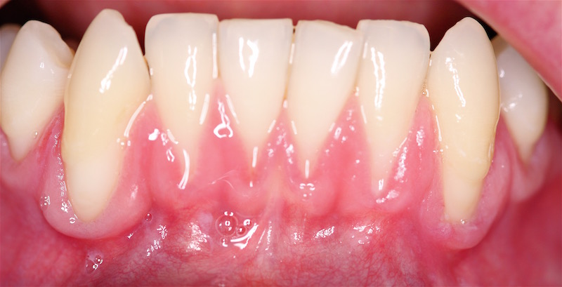 Before photo of gummy smile correction