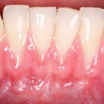 Before photo of gummy smile correction