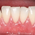 after gummy smile correction photo