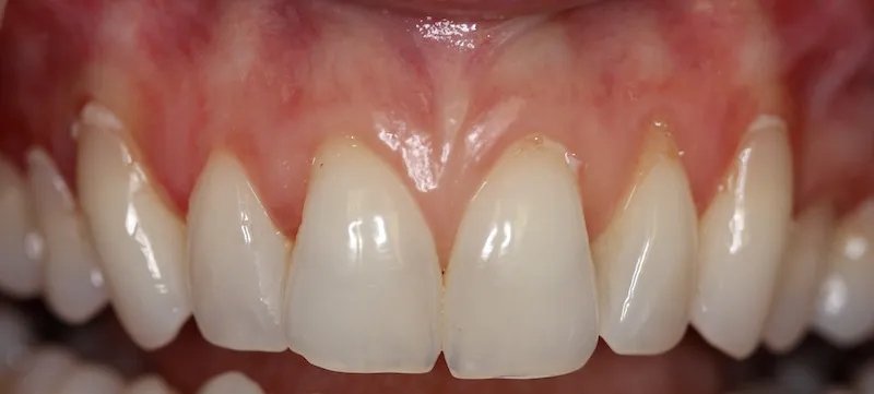 Smile After Gum Grafting