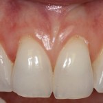 Smile After Gum Grafting