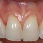 Smile After Gum Grafting
