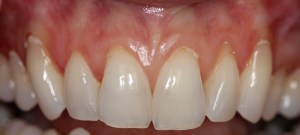 Smile After Gum Grafting