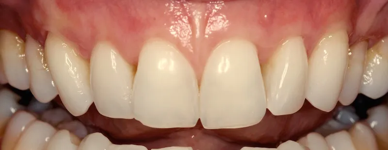 Smile After Receiving Cosmetic Periodontal Services