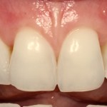 Smile After Receiving Cosmetic Periodontal Services