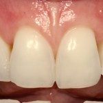 Smile After Receiving Cosmetic Periodontal Services