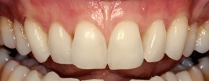Smile After Receiving Cosmetic Periodontal Services