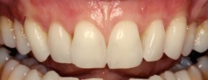 Smile After Receiving Cosmetic Periodontal Services