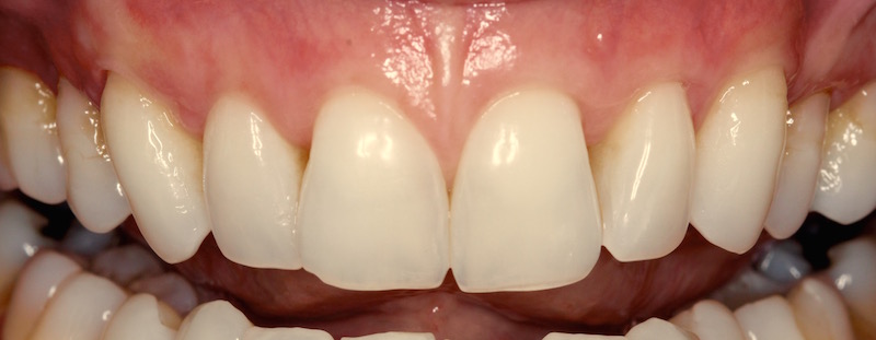Smile After Receiving Cosmetic Periodontal Services