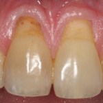 Picture of Teeth before gum grafting surgery