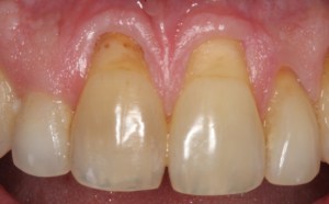 Picture of Teeth before gum grafting surgery