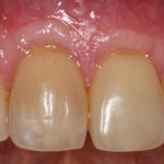 Picture of Teeth before gum grafting surgery