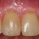 Picture of Teeth before gum grafting surgery