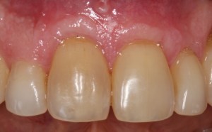 Picture of Teeth before gum grafting surgery